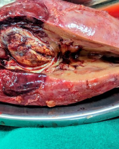 Kidney cancer